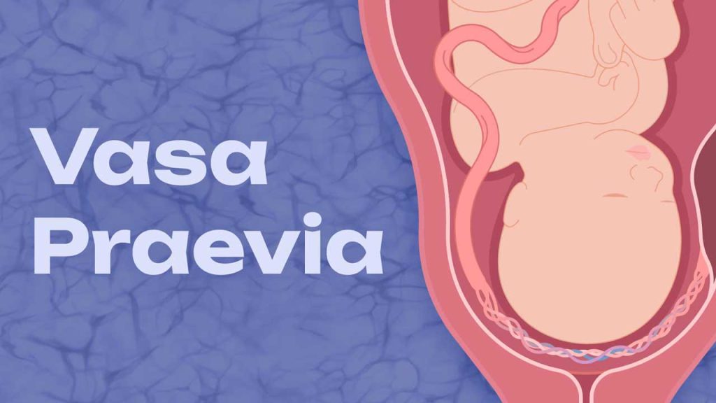 What Is The Cause Of Vasa Previa?