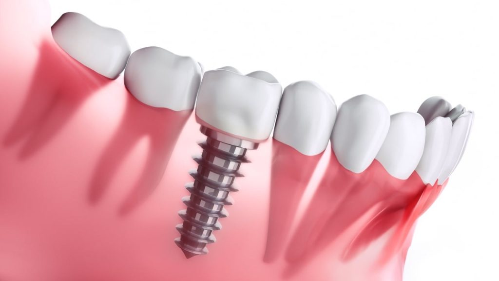 Dental Implant Cost in Korea High-Quality Care at a Reasonable Price